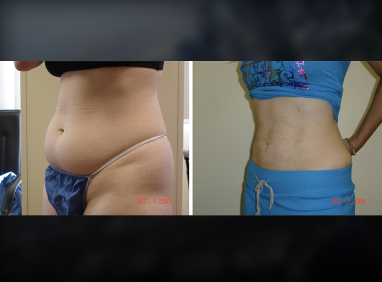 Stomach before and after